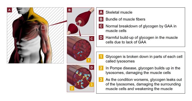 Acumulação de glicogénio nas células devido à falta de AGA