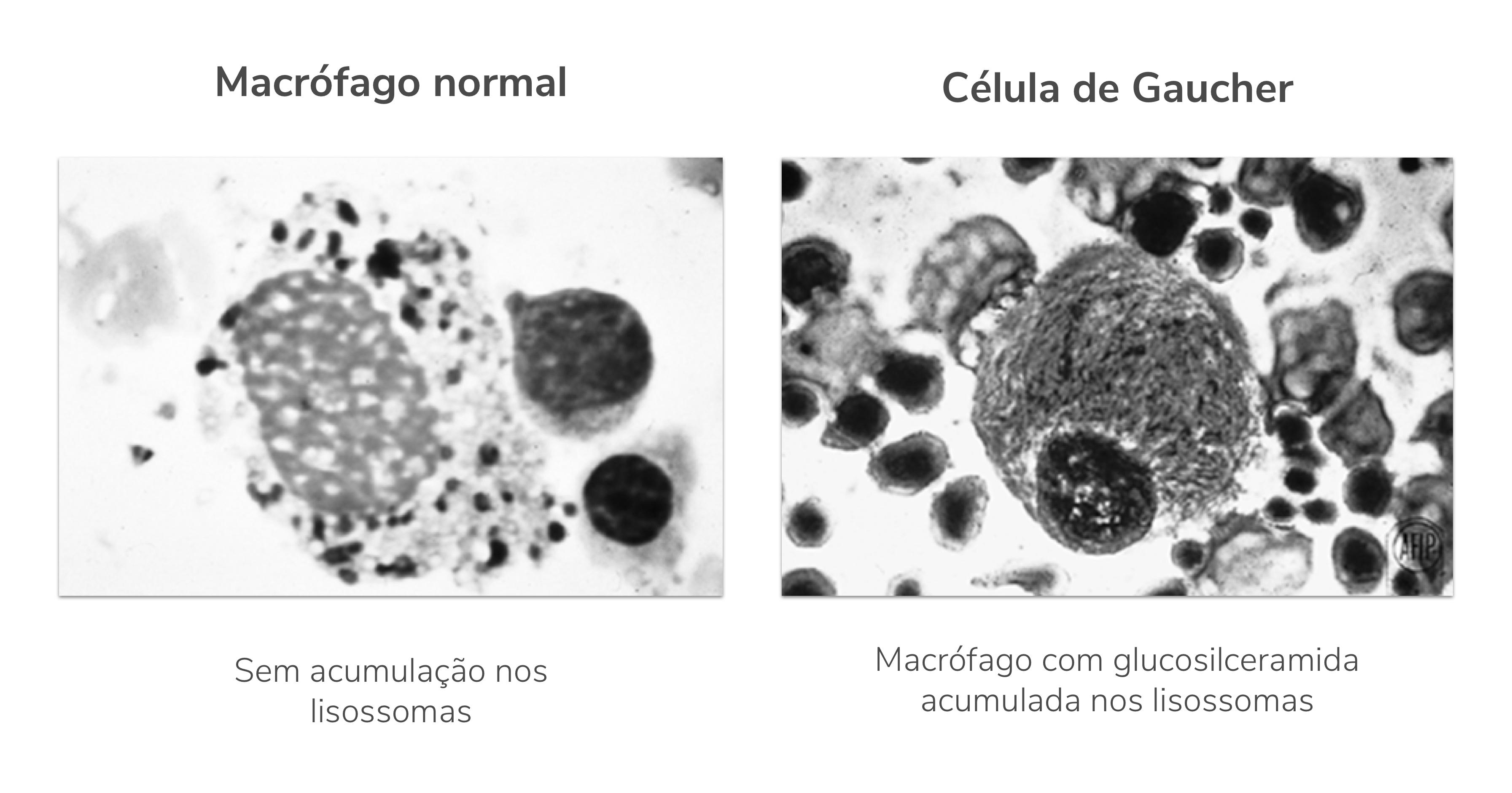 "Células de Gaucher” aumentadas devido à acumulação de glucosilceramida